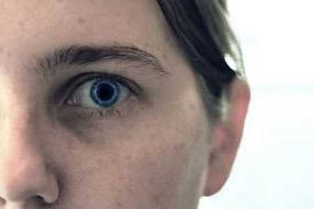 Пигментация роговицы глаза. причины цветовых пятен роговицы глаза, виды и возможное лечение