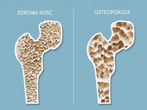 Остеопороз (потеря костной массы) является широко распространенным заболеванием.