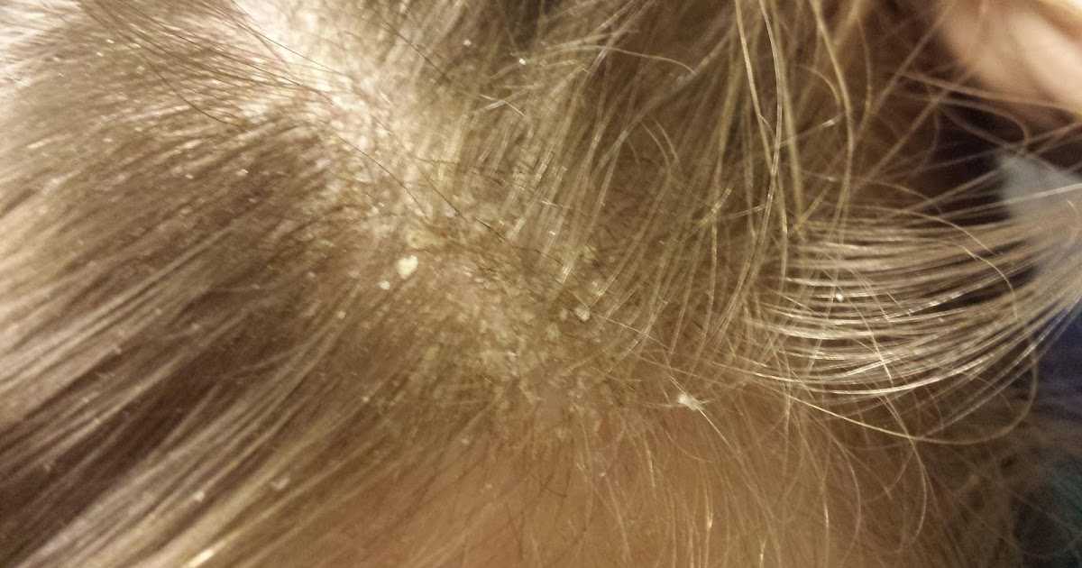 Сухая перхоть: лечение и причины | средства для ухода за волосами alerana