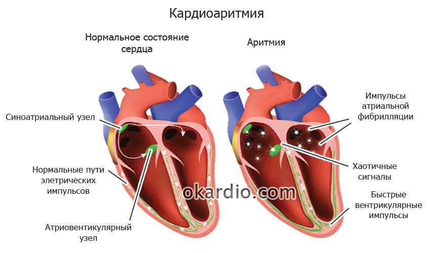 Аритмия сердца: симптомы, лечение