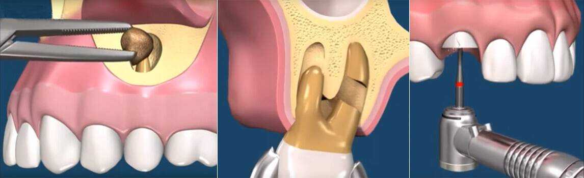Кариес зубов — симптомы, виды, причины, профилактика | «см-стоматология»