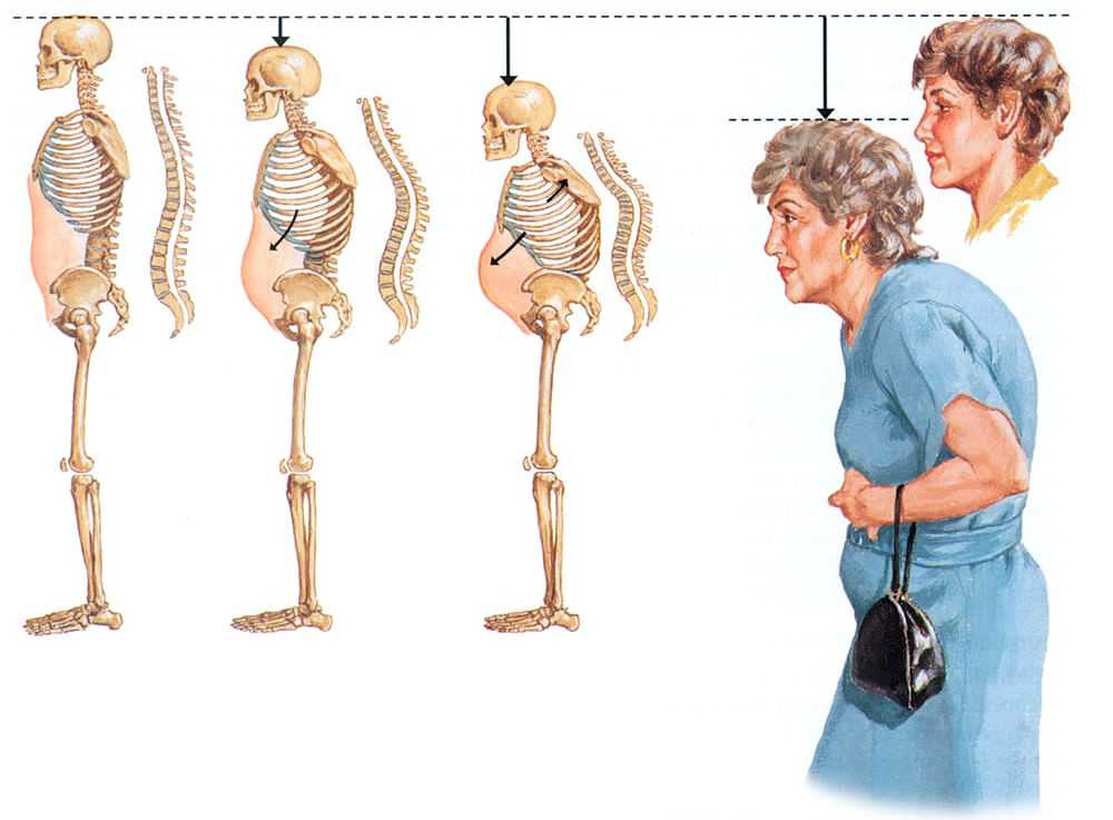 Изменение костей при остеопорозе