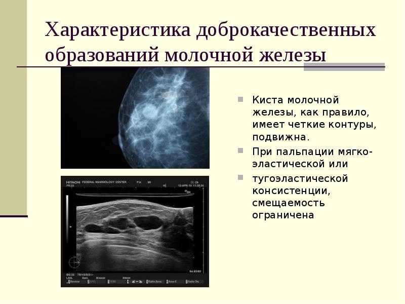 Киста яичника лечение, операция по удалению кисты яичника полостная, лапароскопия кисты цена