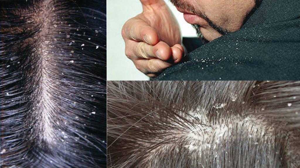 Сухая себорея кожи головы: причины и лечение сухой себореи