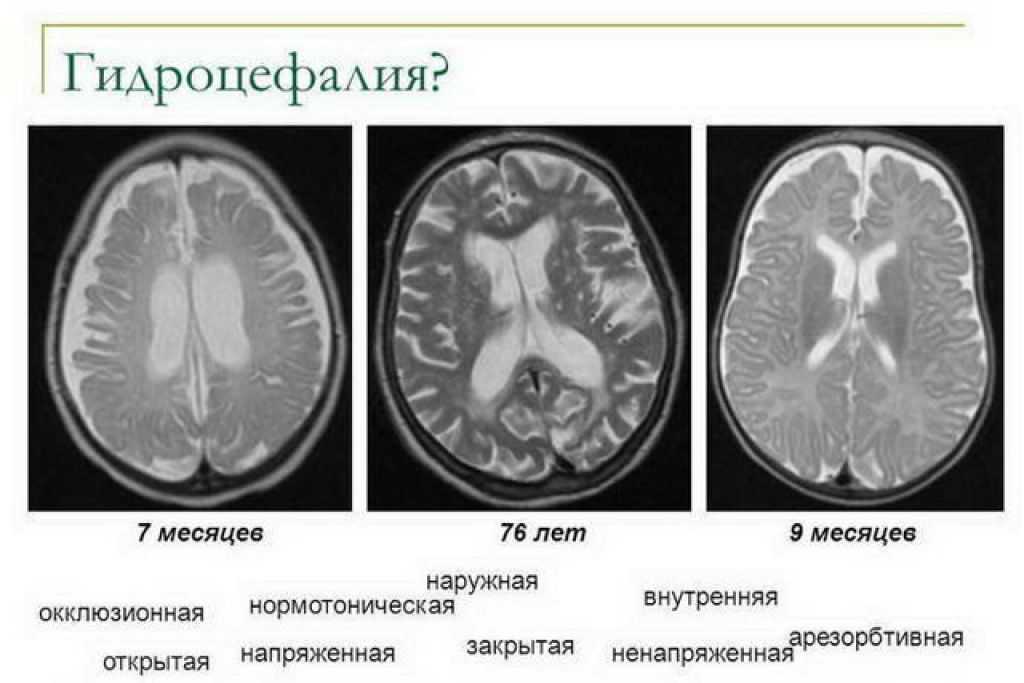 Причины гидроцефалии мозга. Заместительная наружная гидроцефалия кт. Гидроцефалия головного мозга на кт. Наружная гидроцефалия головного мозга мрт.
