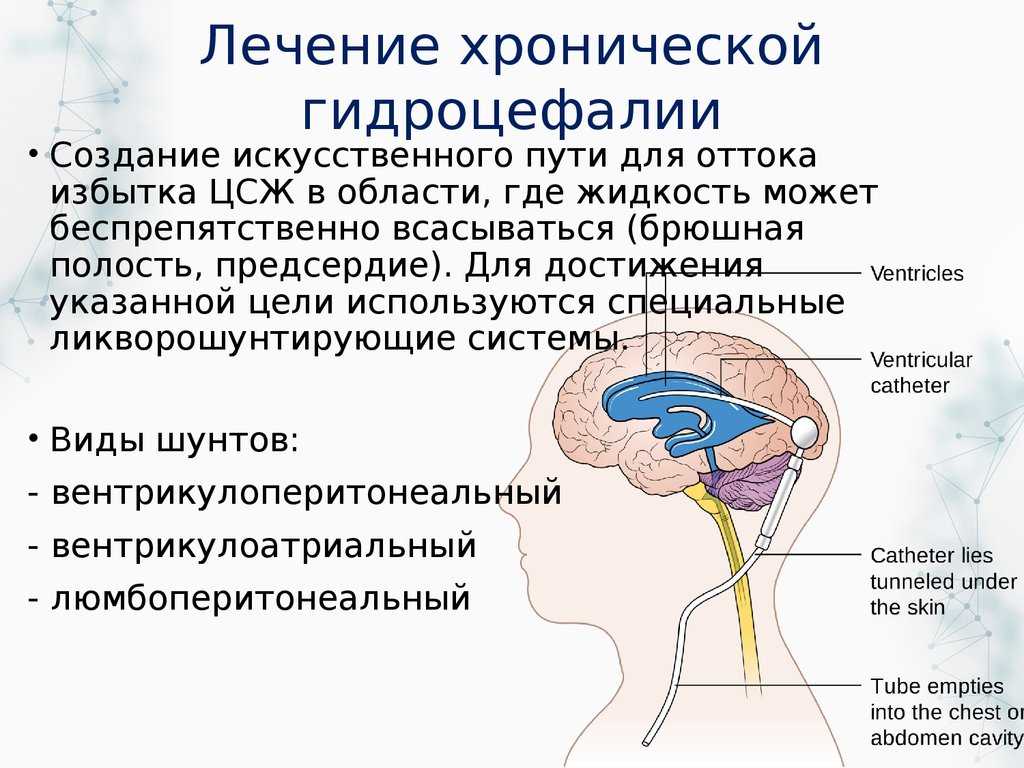 Лечение изменения мозга. Шунт головной мозг ликвора. Водянка желудочков головного мозга. Наружное шунтирование головного мозга.