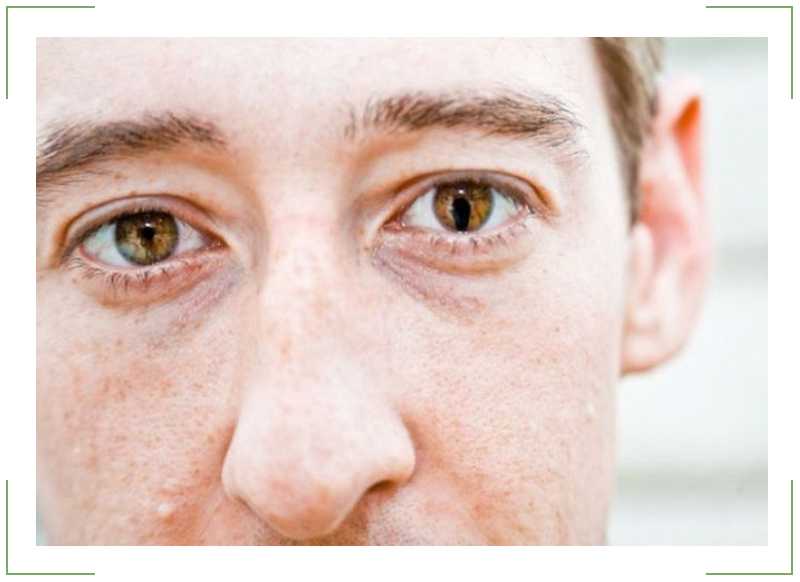 Зрачки наркомана: как определить наркомана по глазам