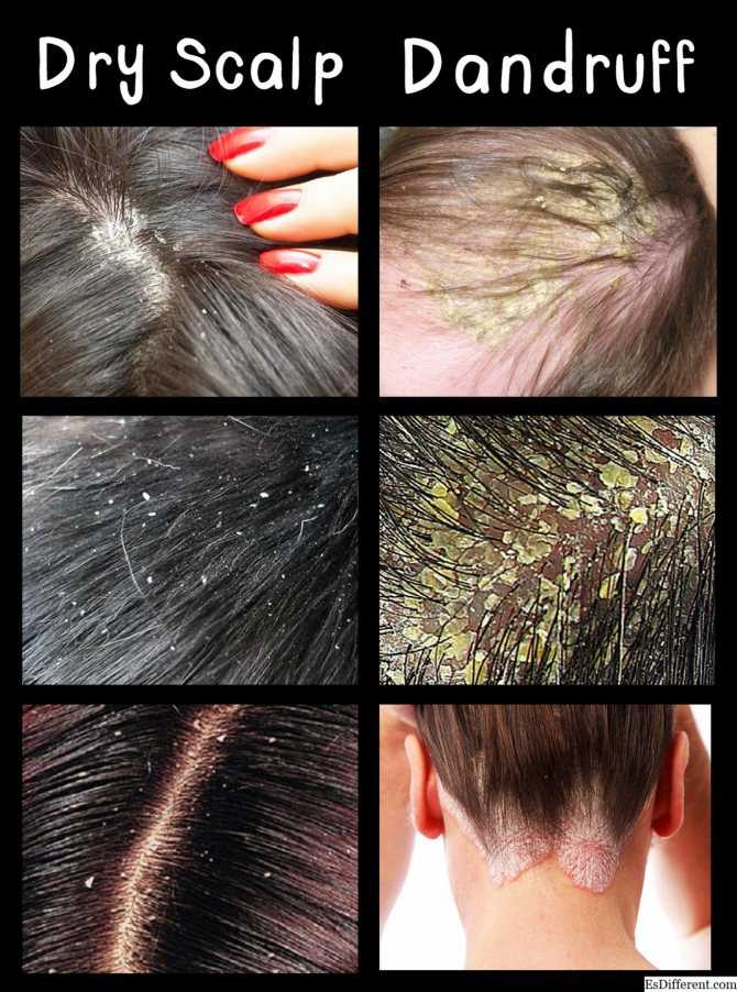 Сухая перхоть: лечение и причины | средства для ухода за волосами alerana