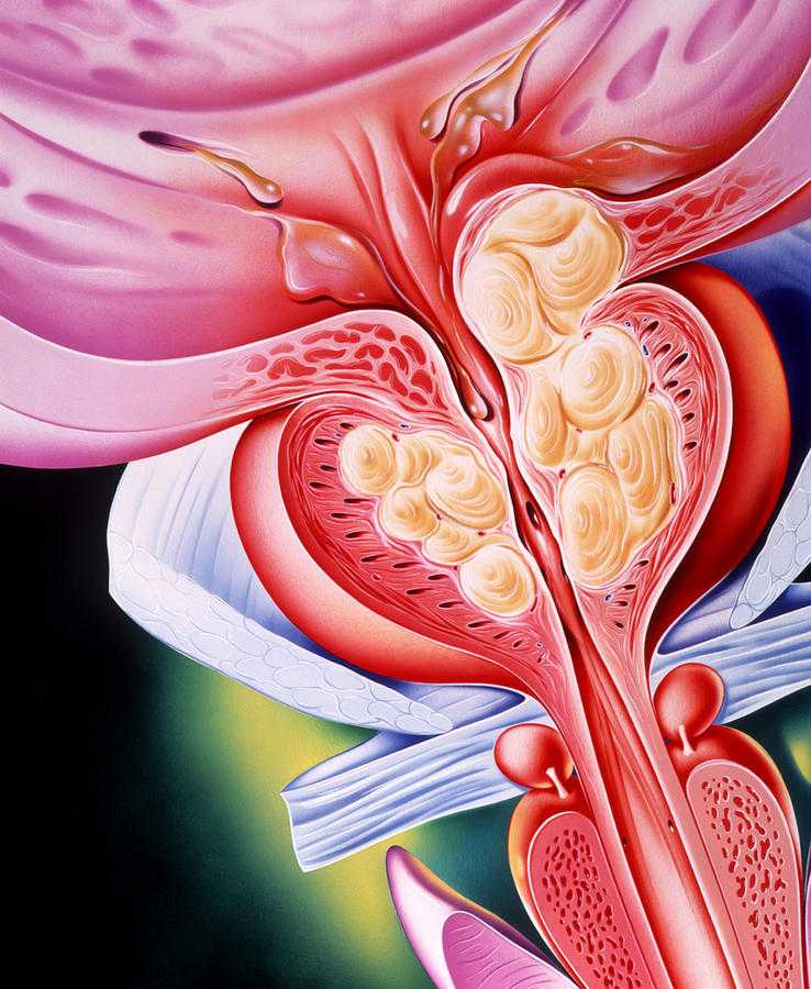 Предстательная железа, Prostata. Аденома предстательной железы. Предстательная железа аденома простаты. Красивая простата