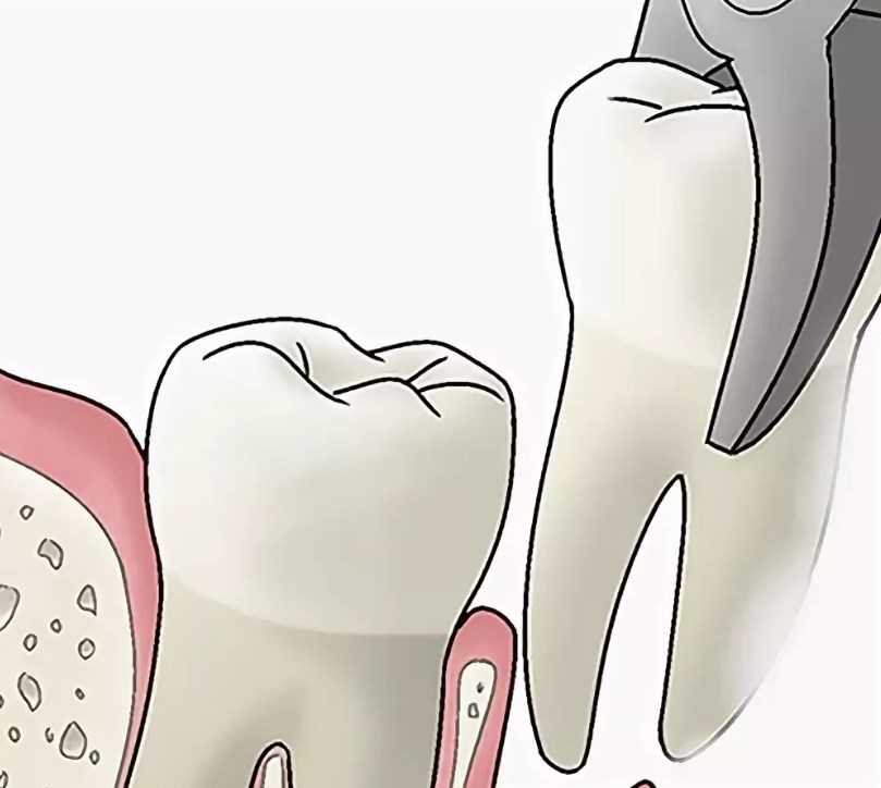 Зубы мудрости - нарушение прикуса и прорезывание восмерок - удалять их или нет?