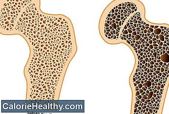 Остеопороз: симптомы, диагностика и лечение остеопороза. как снизить риск переломов: профилактика остеопороза