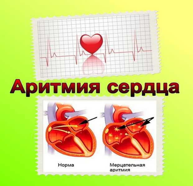 Covid-19 и нарушения ритма сердца