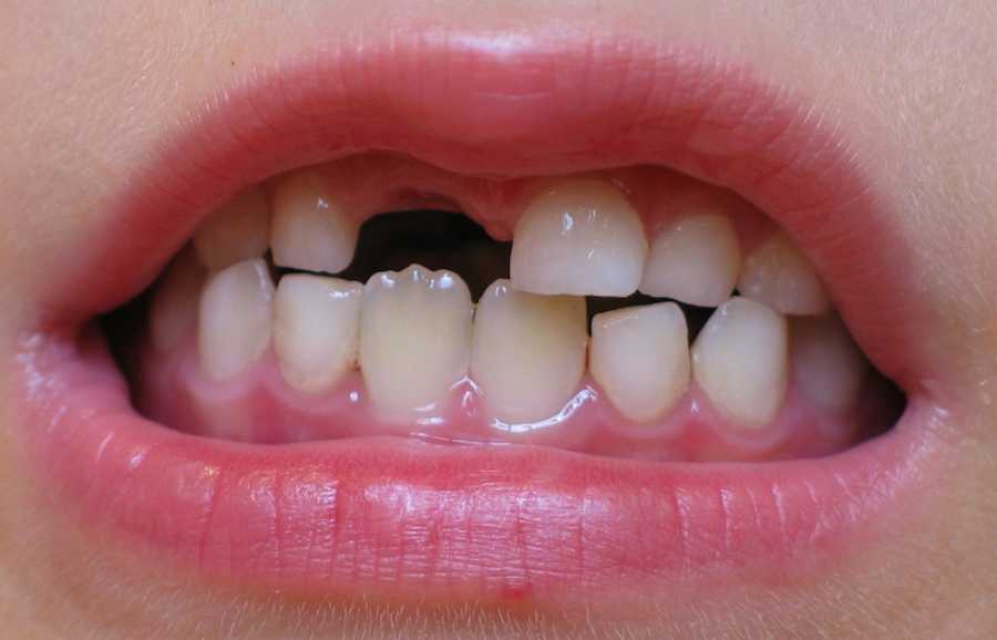 Последовательность выпадения молочных зубов | colgate®