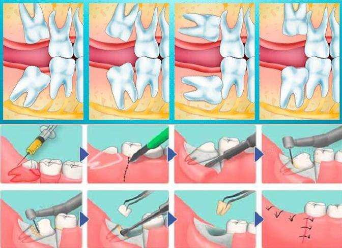 Зубы у шиншиллы (количество, описание, заболевания, лечение): почему шиншилла стучит или скрипит (малоклюзия) зубами
