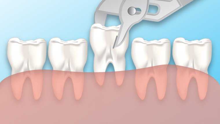 Проблемы с зубами у шиншилл: малокклюзия, стачивание, выпадение и удаление зубов и способы лечения