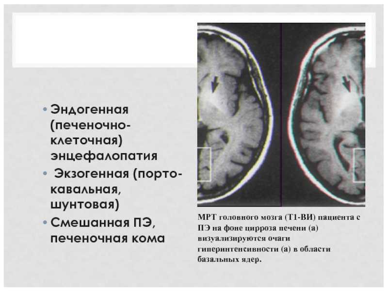 Стадии печеночной энцефалопатии. Печеночная энцефалопатия мрт. Печеночная энцефалопатия и печеночная кома. Печеночная энцефалопатия мрт мозга. Печеночная энцефалопатия на кт головной мозг.