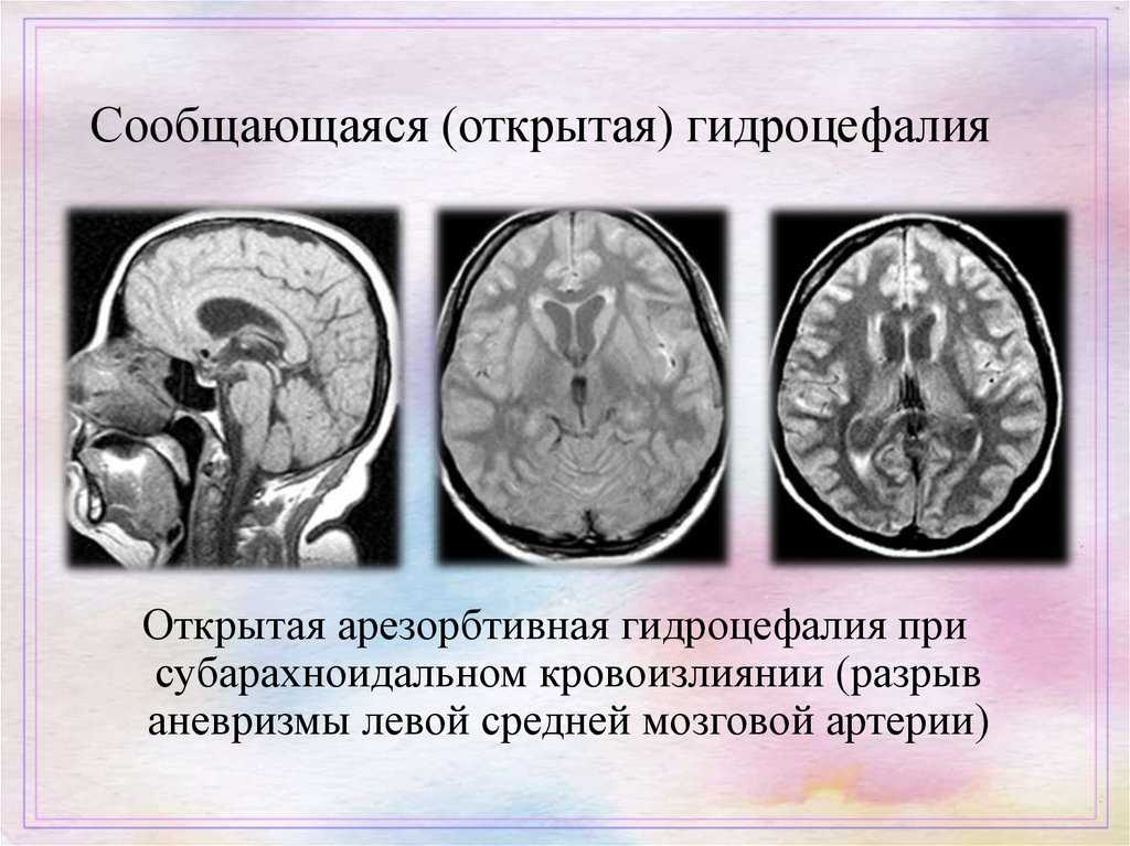 Неокклюзионная гидроцефалия. Гидроцефалия УЗИ головного мозга. Наружная гидроцефалия головного мозга кт. Арезорбтивная гидроцефалия. Викарная наружная сообщающаяся гидроцефалия.