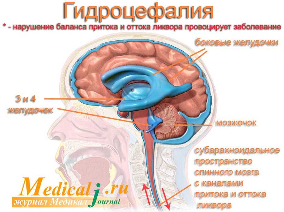 Причины гидроцефалии мозга