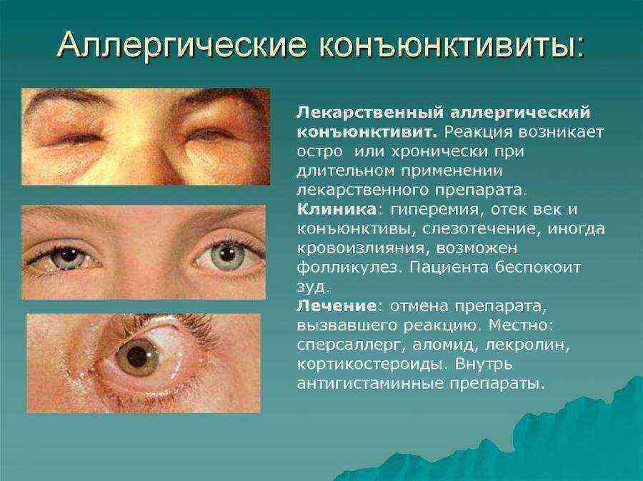 Покраснение глаз: основные причины и заболевания, вызывающие покраснение склеры. когда при покраснении глаз необходимо обращаться к врачу