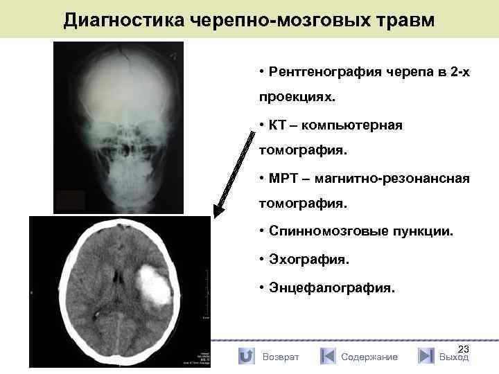 Закрытая черепно мозг травма. Кости свода черепа рентген. Рентгенограмма черепа в двух проекциях. Закрытая черепно мозговая травма рентген. Рентген основания черепа.